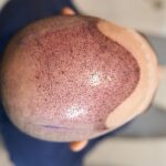 Ordu’da Saç Ekim Merkezleri ve Saç Ekimi Fiyatları