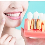 Diş İmplantları Hakkında Bilmeniz Gereken 9 Bilgi!