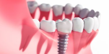 konya implant (2)