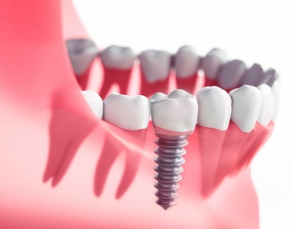 konya implant (2)