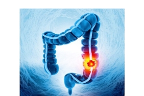 uzun-sureli-ulseratif-kolitte-kolon-kanseri-riski-artiyor-mu.jpg