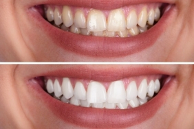 zirkonyum diş tedavisi (2)