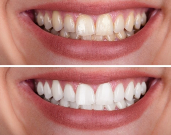 zirkonyum diş tedavisi (2)